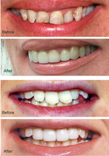 Examples of restorations using Thineers